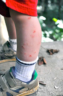 My son's legs covered in mosquito bites