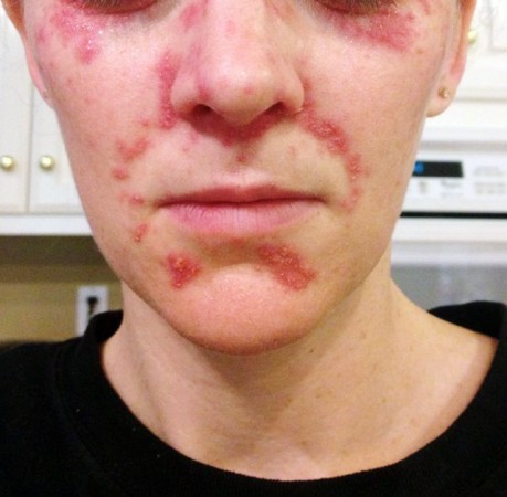 Perioral Dermatitis - Withdrawals from Corticosteroid Cream