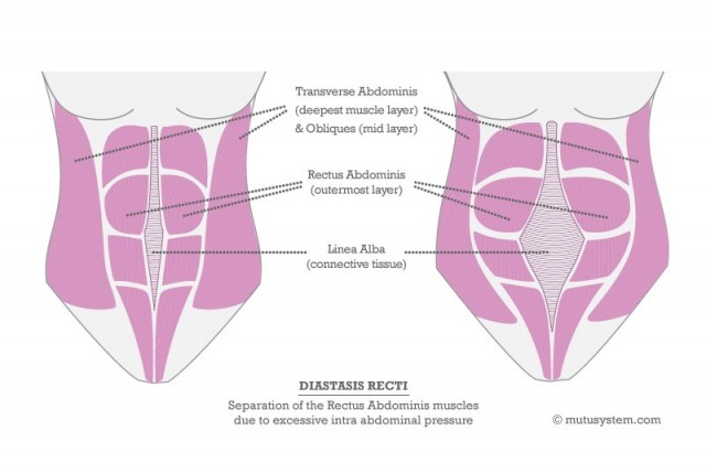 Diastasis Recti - abdominal muscle separation after pregnancy and how to fix it